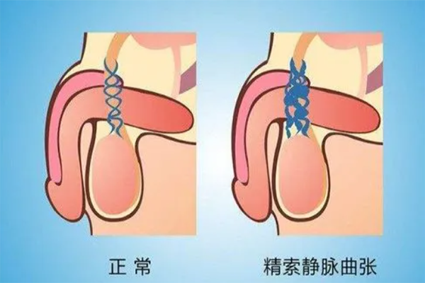 10个青壮年男士中8个人都有精索静脉曲张，真的吗?