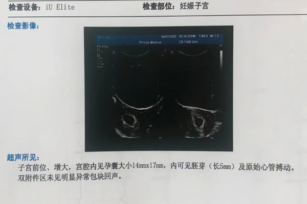 胎囊数据看男女不准确