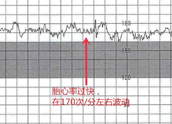 运动过多会导致胎心率过快