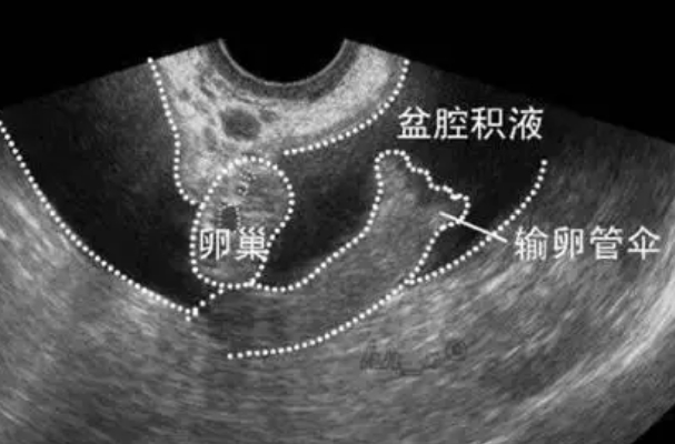 盆腔积液2.8cm需一个月后移植