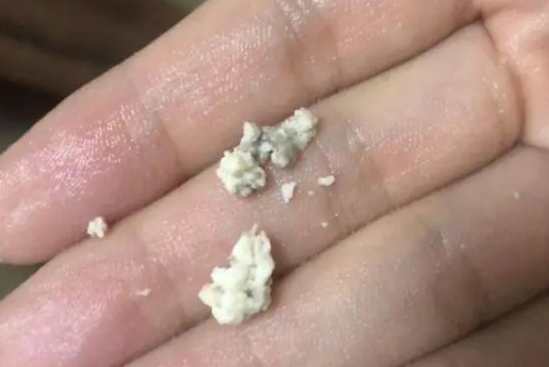 雪诺酮药渣可以直接用手指抠