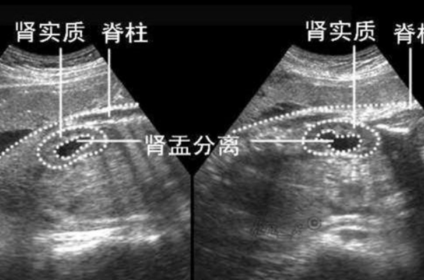 尿路感染会导致肾盂分离