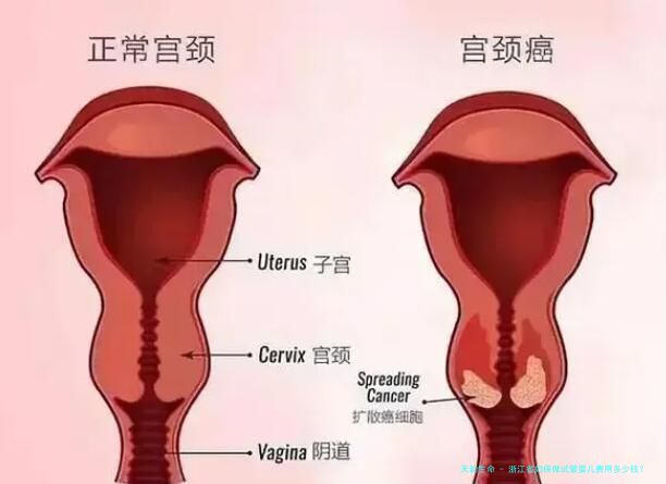 浙江省妇保做试管婴儿费用多少钱？