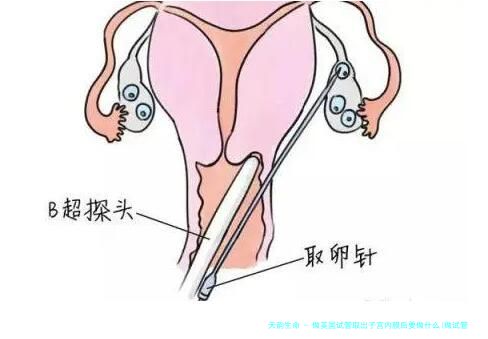 做美国试管取出子宫内膜后要做什么(做试管取内膜的意义)