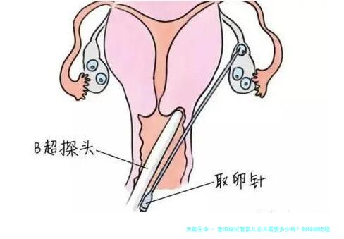 普洱做试管婴儿总共需要多少钱？附详细流程及费用清单！