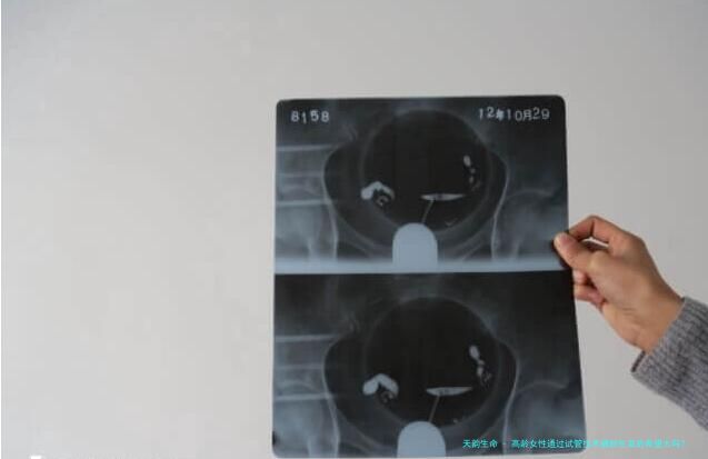 高龄女性通过试管技术辅助生育的希望大吗？