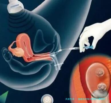 福建泉州做试管婴儿哪里好