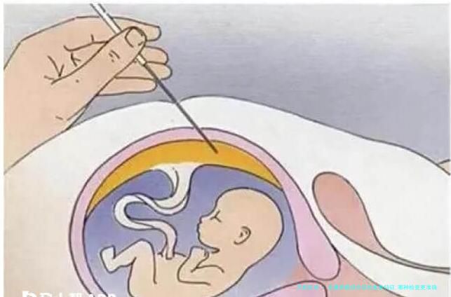 多囊卵巢综合征的血象特征,哪种检查更准确？医生建议这样做!