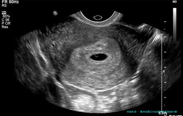 衢州试管三代比较好的医院排行榜
