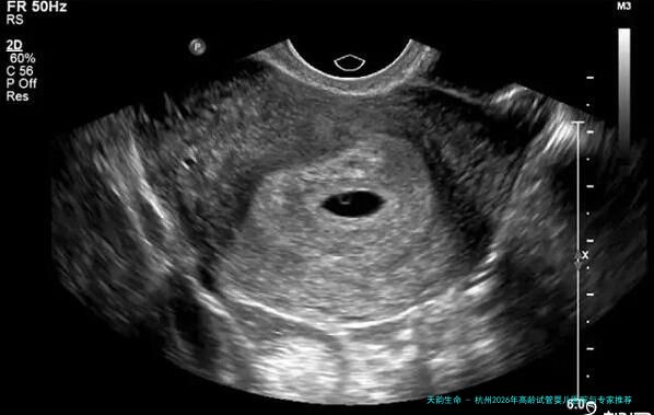 杭州2026年高龄试管婴儿医院与专家推荐：邵逸夫医院生殖中心、浙江省妇保医院等机构领衔