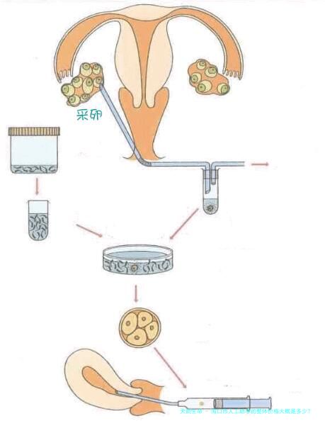 海口市人工助孕的整体价格大概是多少？