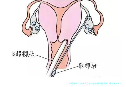 武汉公立助孕机构哪家技术强？成功率如何？