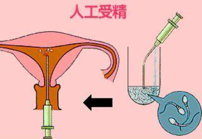 详解供精人工授精的流程和费用，你想知道的都在里面！