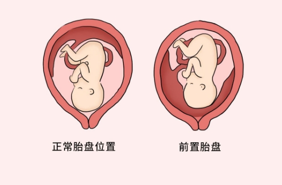 胎盘前置和走路多无关