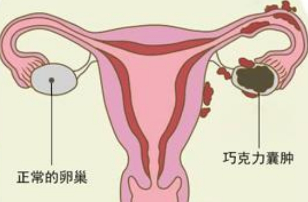 5公分巧克力囊肿不切除可以试管吗？