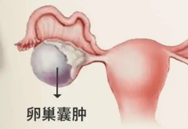 5毫米右附件囊肿需手术后再做试管