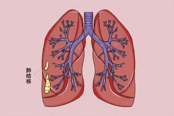 结核病治愈后可以试管