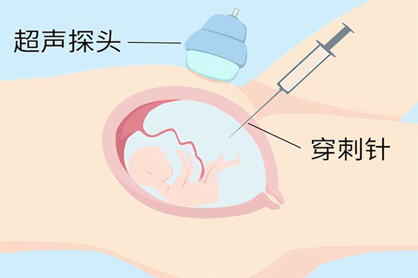 羊水穿刺翻盘的几率不高