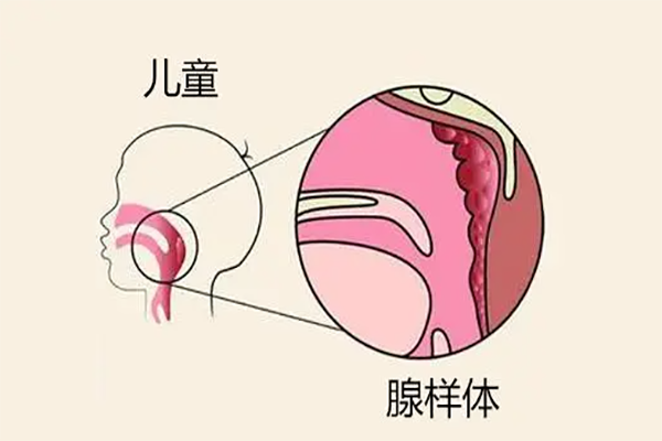 摘除腺样体会影响免疫力