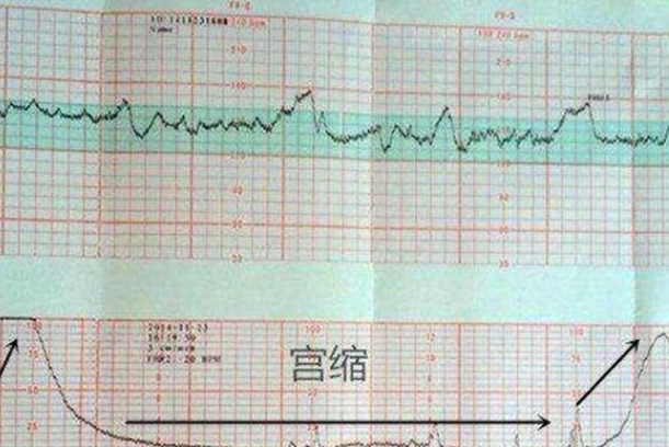 胎心率过慢可能是宫缩