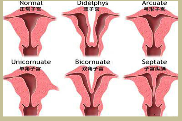 女性子宫畸形是什么样子的，有真实图片吗