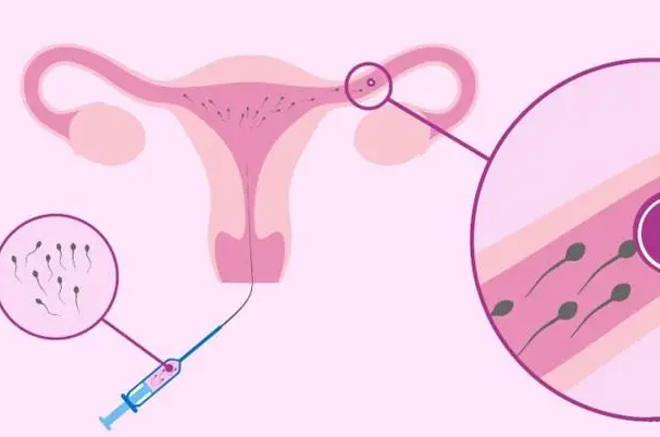 人工授精会伤到子宫内膜