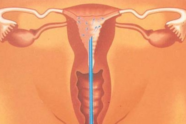 宫腔灌注会对子宫有伤害