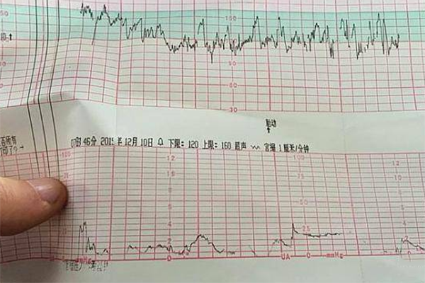 胎心率160以上是宝宝在子宫内缺氧吗?