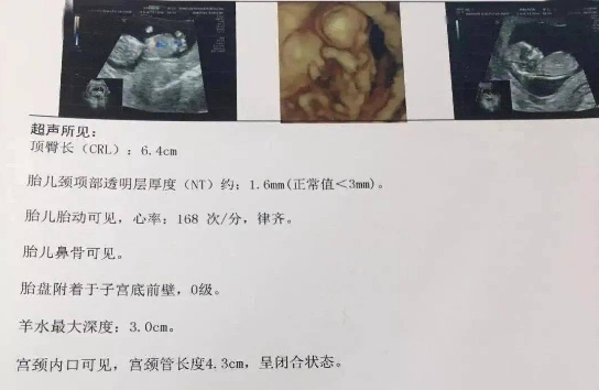 nt正常值是小于2.5毫米