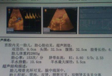 有人说b超单有这个“f”字母一般是女孩是真的吗？