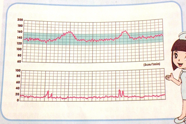 胎心监护其实不是一个坑