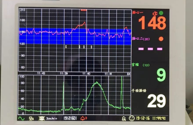 孕8个月胎心监护连续2次不合格就必须住院治疗吗？