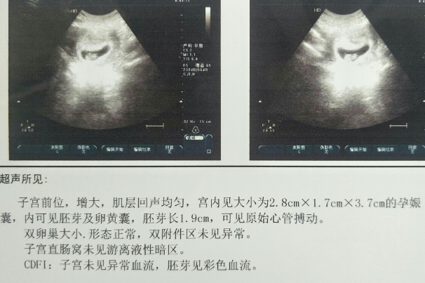 医生经验不足导致B超结果不同