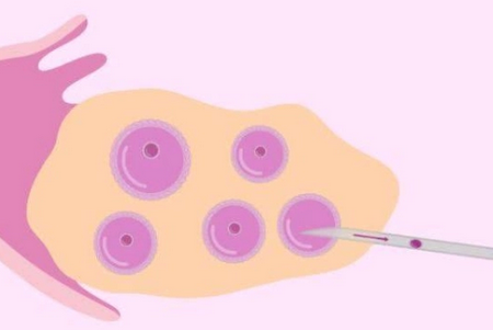 真有促排一个优势卵泡移植到子宫里怀了双胞胎的例子吗？