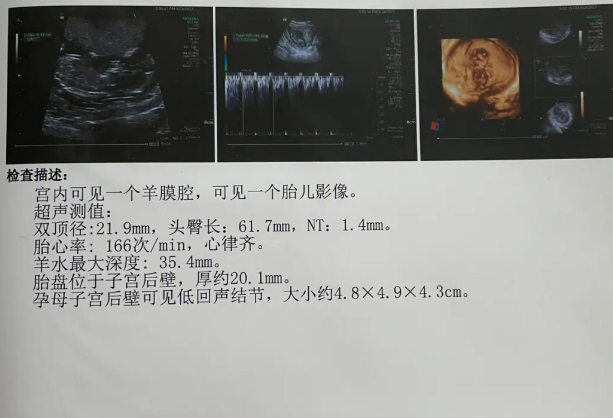 B超nt小于1.5一般是生男孩吗？