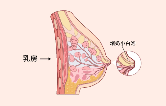 母乳堆积是堵奶的最重要因素