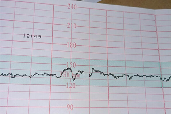 胎心少于120有缺氧的可能
